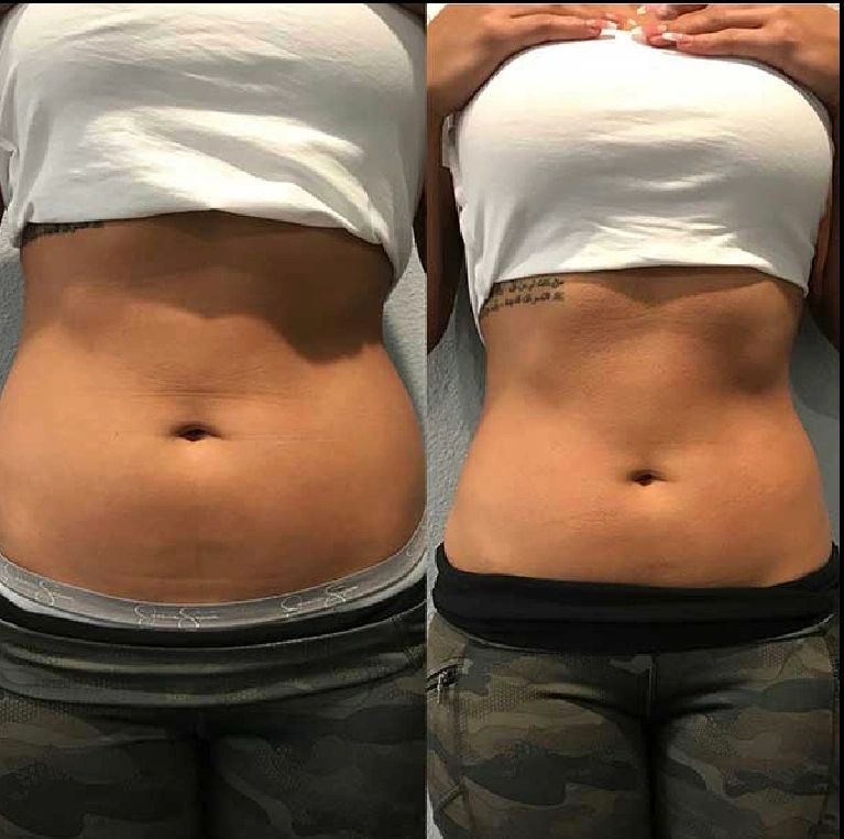 Before-and-after abdomen photos shown side by side