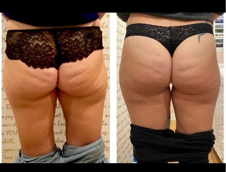 Before-and-after thigh photos shown side by side