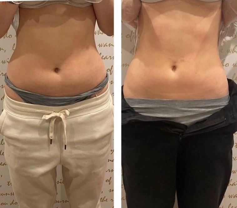 Before-and-after waist photos shown side by side
